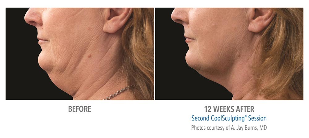 Before and after second coolsculpting session