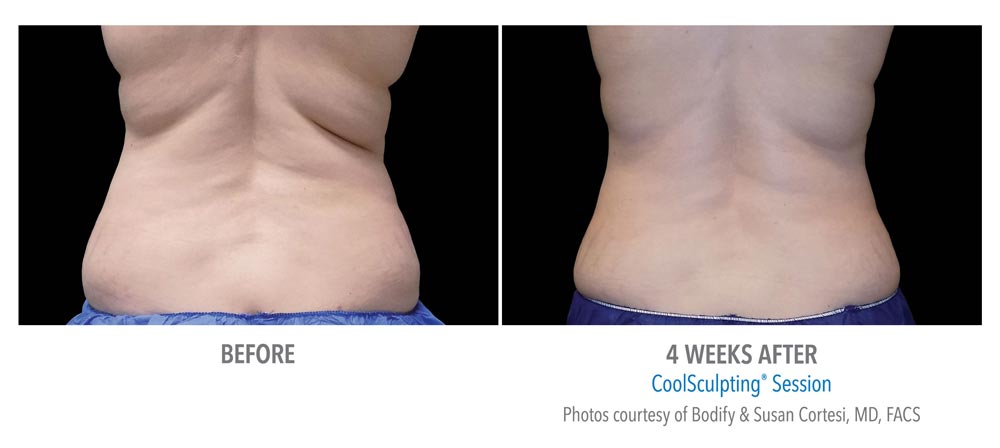 Before and after bra bulge treatment with coolsculpting