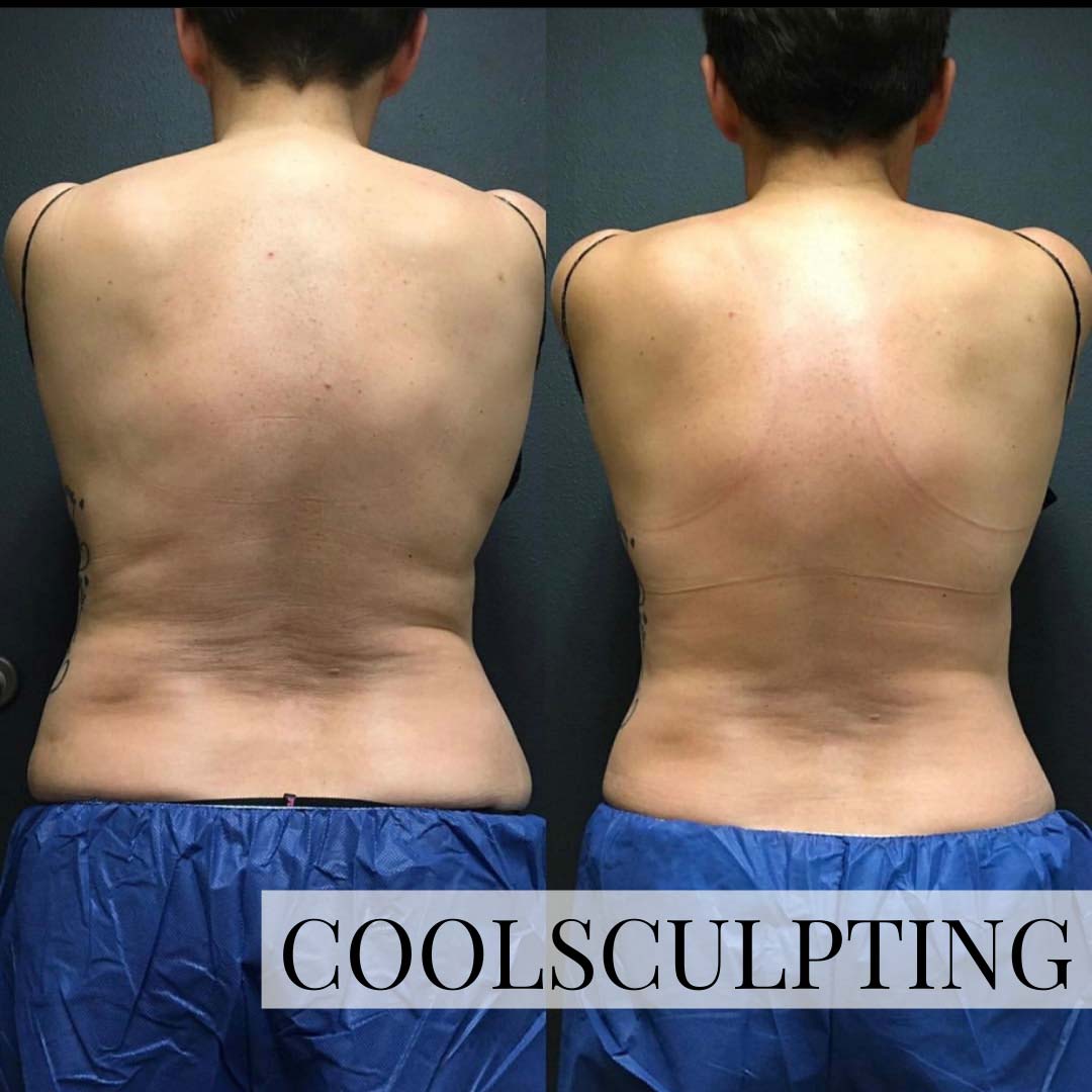 Back of woman after Coolsculpting