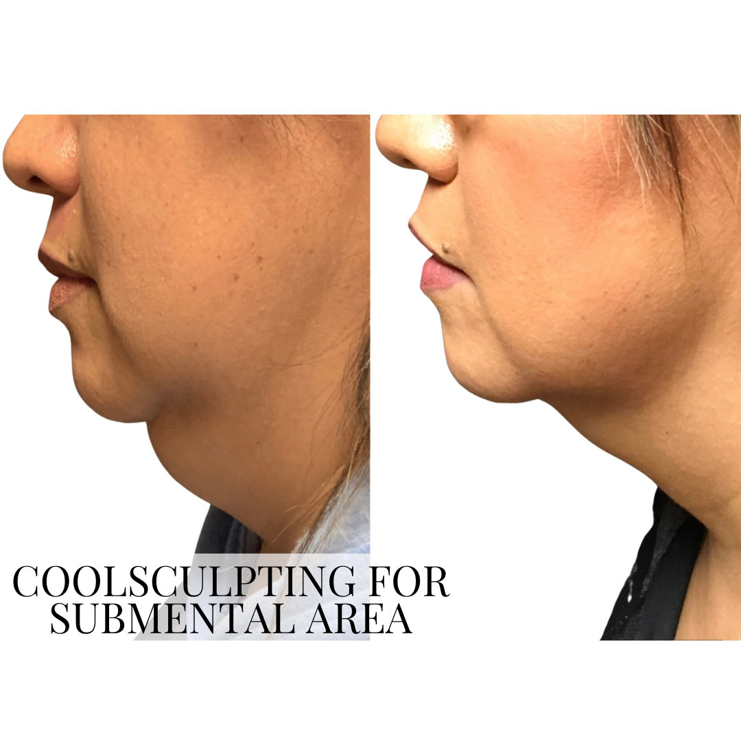 Before and after coolsculpting double chin removal